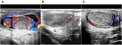 Immunoglobulin a vasculitis with testicular/epididymal involvement in children: A retrospective study of a ten-year period